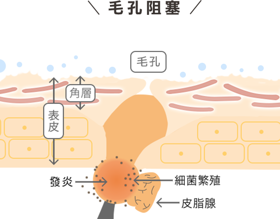 つまってぷくっ